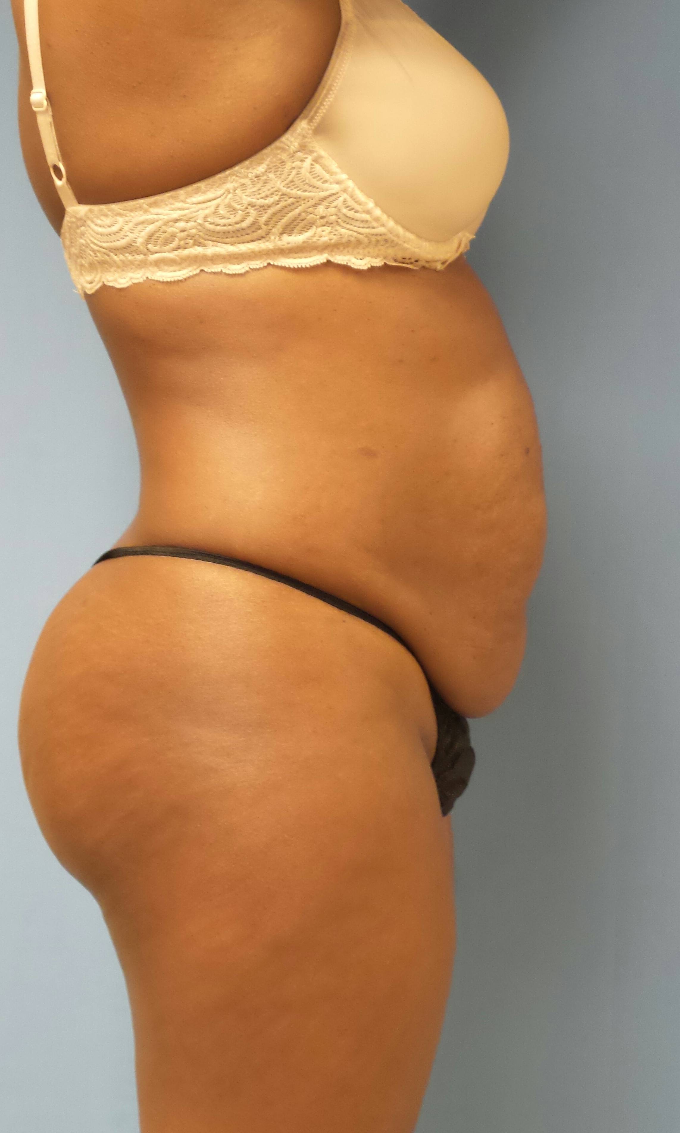 Tummy Tuck New Jersey, Abdominoplasty